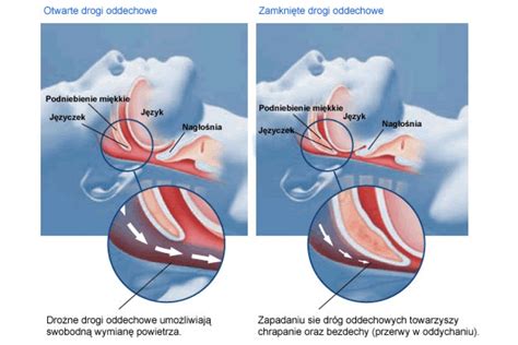 sleep apnea po polsku|Obturacyjny bezdech senny — diagnostyka i .